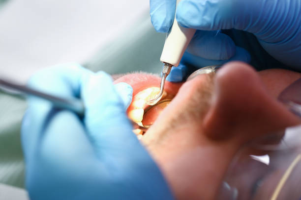 Best Emergency Wisdom Tooth Extraction in Grandview, OH