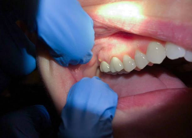 Best Emergency Denture Repair in Grandview, OH